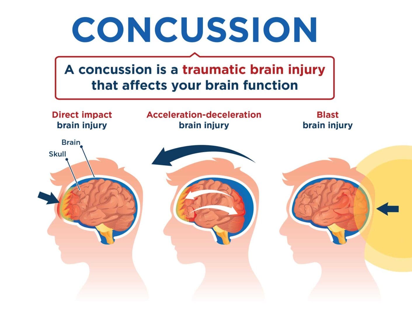 A diagram of three different types of concussion.